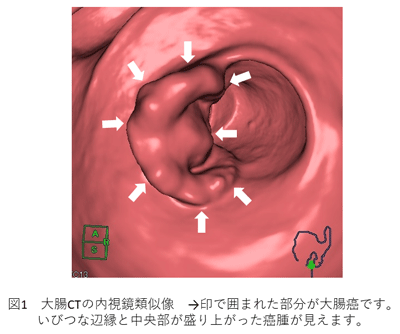 大腸ct検査について教えてください 市民のみなさまへ 日本大腸肛門病学会