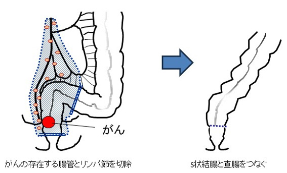 図3　直腸がんに対する低位前方切除術