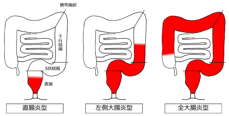 図1　病変の広がりによる潰瘍性大腸炎の病型分類