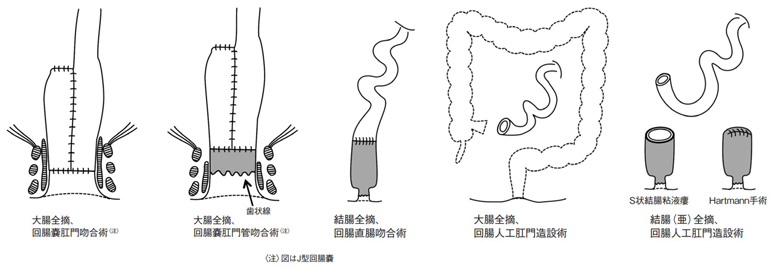 図2　潰瘍性大腸炎に対する主な手術術式（潰瘍性大腸炎・クローン病診断基準・治療指針．令和4年度改訂版より）