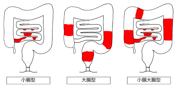 図3　病変の存在部位によるクローン病の病型分類