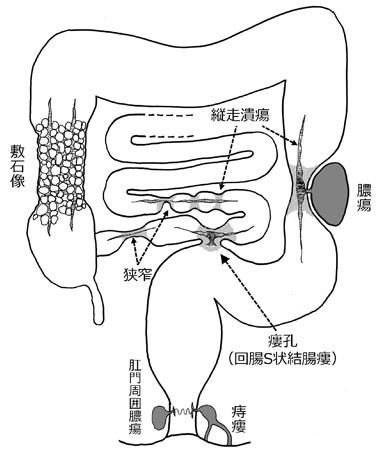 図4　クローン病に特徴的な病変