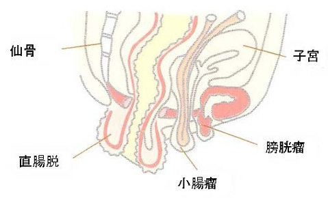図1　直腸脱に合併した小腸瘤、膀胱瘤