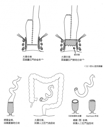 02-図：潰瘍性大腸炎に対する主な手術術式