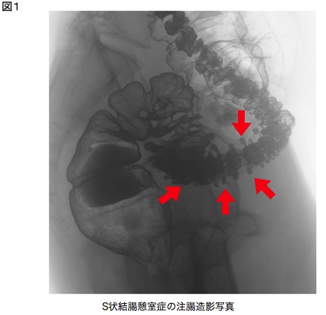 虚 血性 腸炎