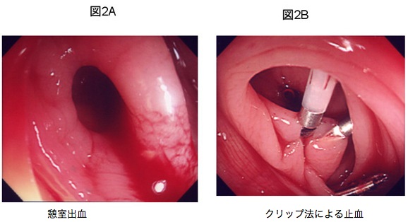 大腸憩室出血 虚血性腸炎 市民のみなさまへ 日本大腸肛門病学会