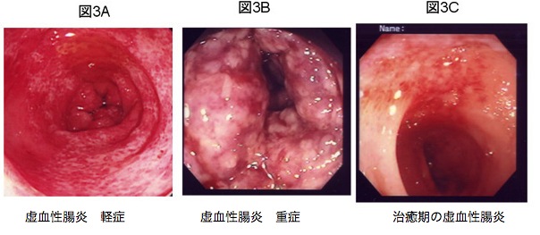 大腸憩室出血 虚血性腸炎 市民のみなさまへ 日本大腸肛門病学会