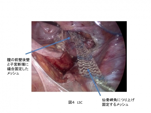 後 子宮 脱 手術 子宮全摘手術から日常生活へ戻るまで