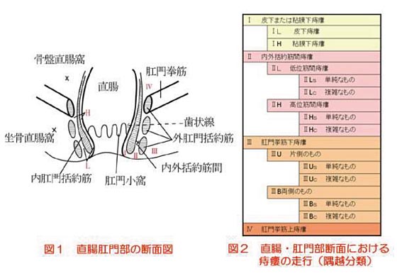 痔瘻の治療 市民のみなさまへ 日本大腸肛門病学会 痔瘻の治療 市民のみなさまへ 日本大腸肛門病学会