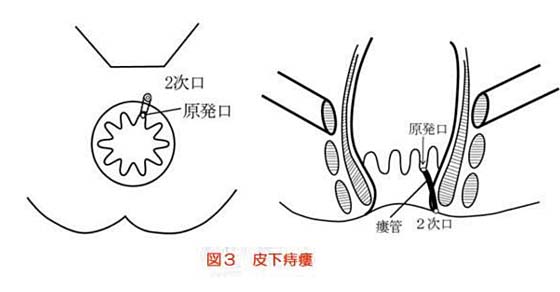 痔瘻の治療 市民のみなさまへ 日本大腸肛門病学会