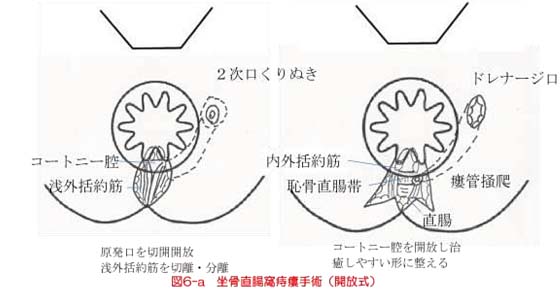 痔瘻の治療 市民のみなさまへ 日本大腸肛門病学会 痔瘻の治療 市民のみなさまへ 日本大腸肛門病学会