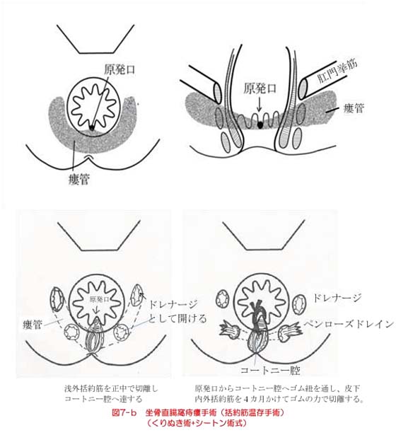 痔瘻の治療 市民のみなさまへ 日本大腸肛門病学会 痔瘻の治療 市民のみなさまへ 日本大腸肛門病学会