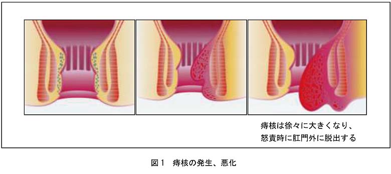 痔核の治療｜市民のみなさまへ｜日本大腸肛門病学会