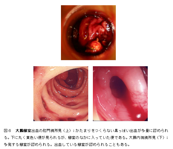 肛門からの出血の状態で 大腸 肛門の病気が分かりますか 市民のみなさまへ 日本大腸肛門病学会